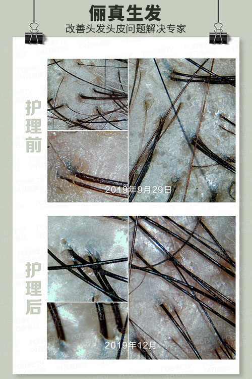 頭油、頭癢
