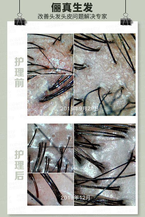 脂溢性皮炎
