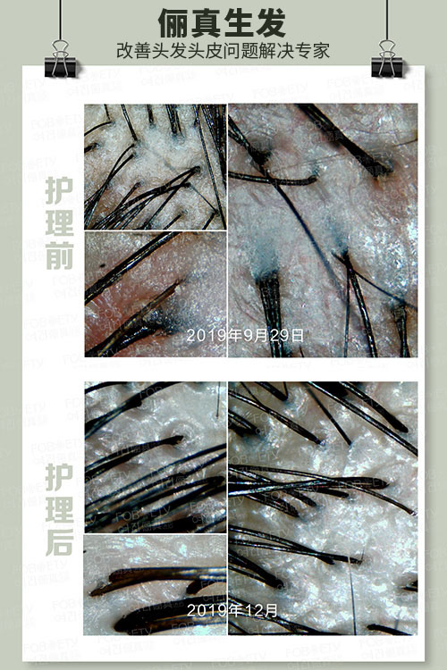 頭油、頭癢