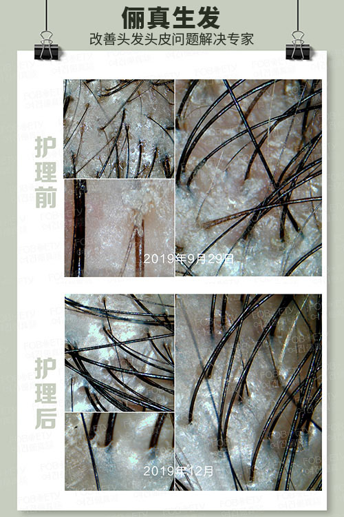 頭油、頭癢